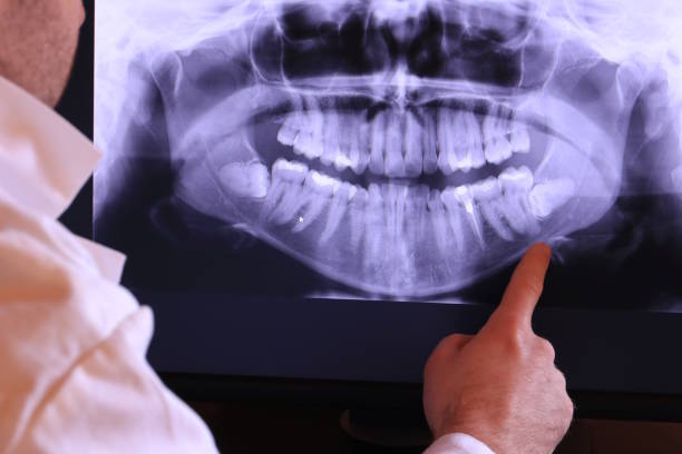 Best Emergency Tooth Extraction in Oak Island, NC